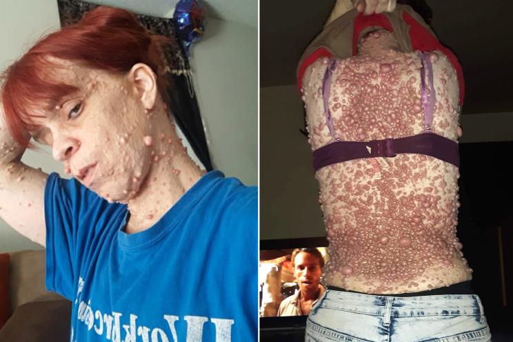 Alabama mom covered in thousands of tumors scared to get them removed